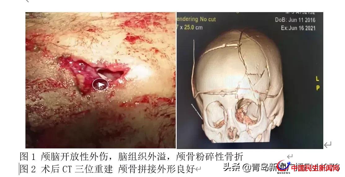 5歲男童6樓墜落命懸一線，婦兒醫(yī)院多學(xué)科協(xié)作再勝“死神”